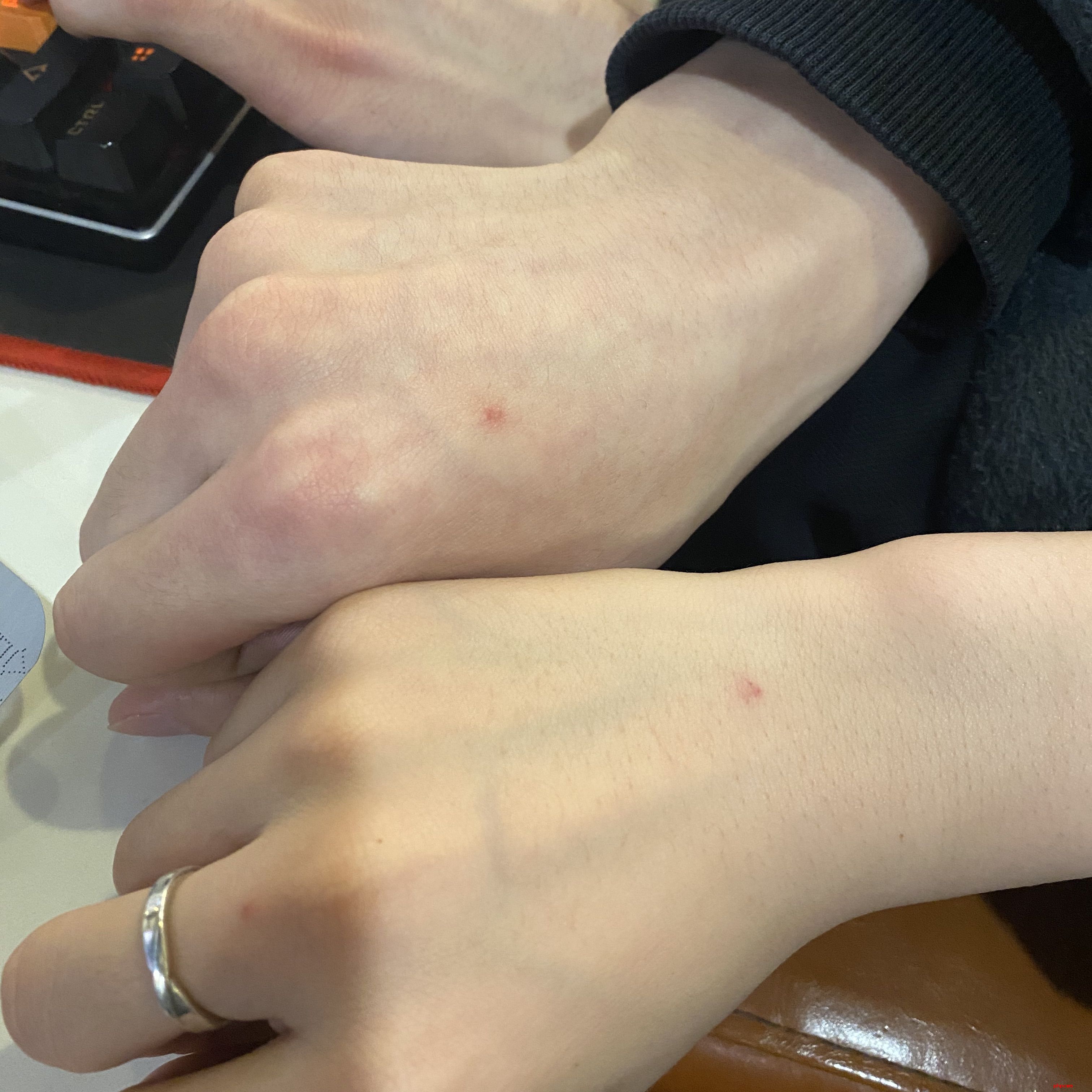 挤破丘疹恐造成二次损伤 广东蚊子如何“防御”？